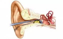 掏耳朵暗藏4大危害，千万别随便掏！正确清理方式是...