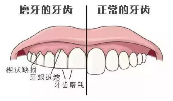 “磨牙”是怎么回事？听我来分析分析