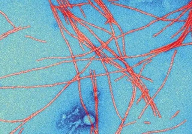 老年痴呆症有救了？首款阿尔茨海默病新药明年初申请上市