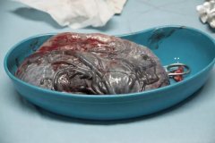 产科专家：为什么我不建议你吃胎盘