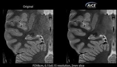 佳能医疗AI算法获FDA批准，将应用于公司的MR设备