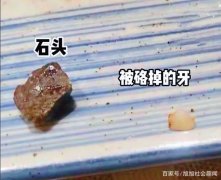 男的说在餐厅吃饭被石头切断了 没人管